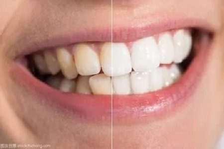 牙齿变白有哪些方法