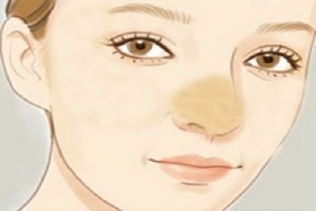 鼻形歪的原因是什么
