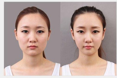 北京打瘦脸针需要多少钱